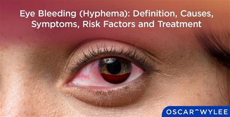 Eye Bleeding Symptoms, Causes, and Treatment